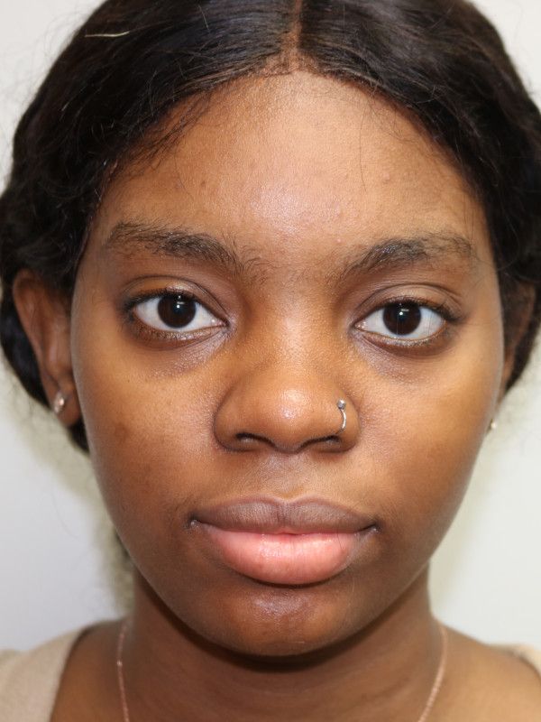 Otoplasty Before & After