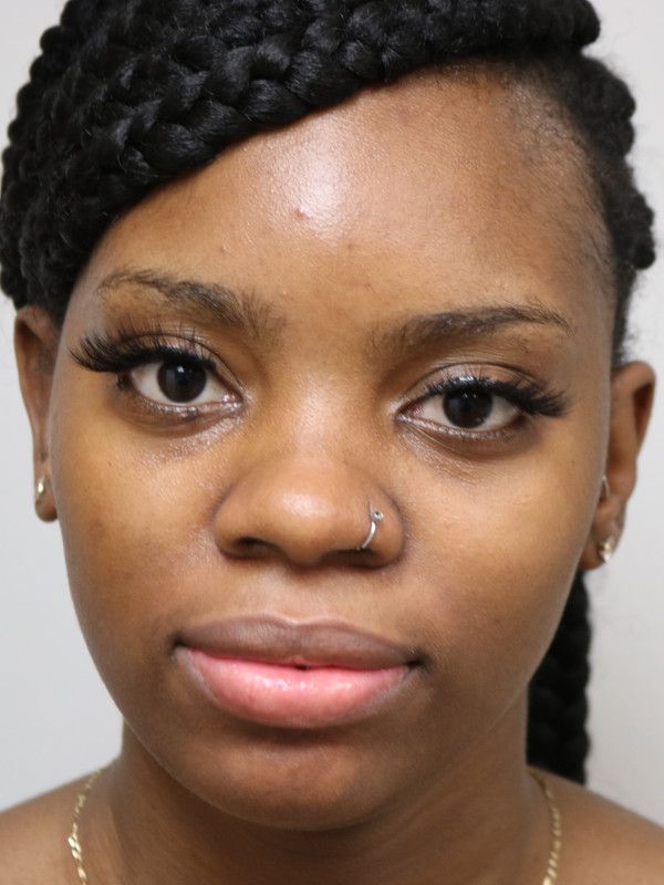 Otoplasty Before & After
