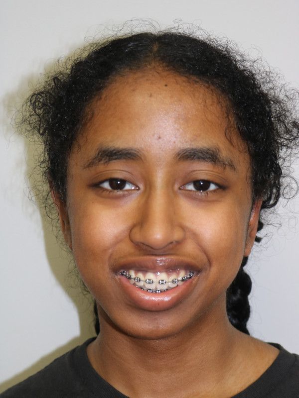 Otoplasty Before & After