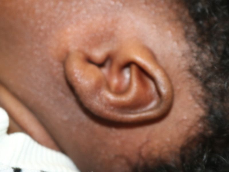 Otoplasty Before & After