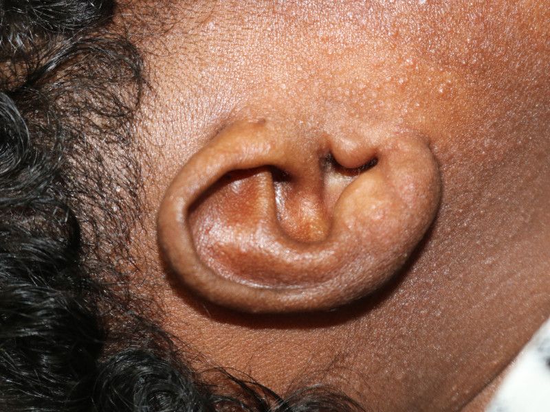 Otoplasty Before & After