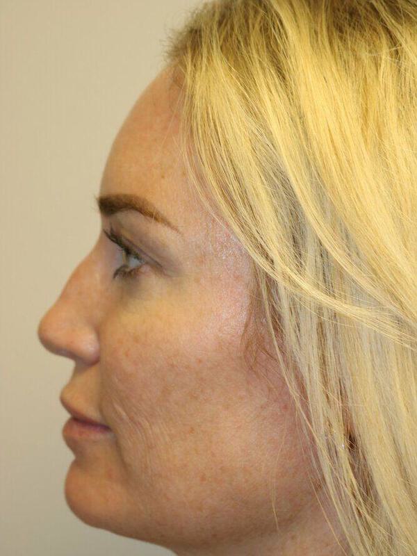 Rhinoplasty Before & After Image