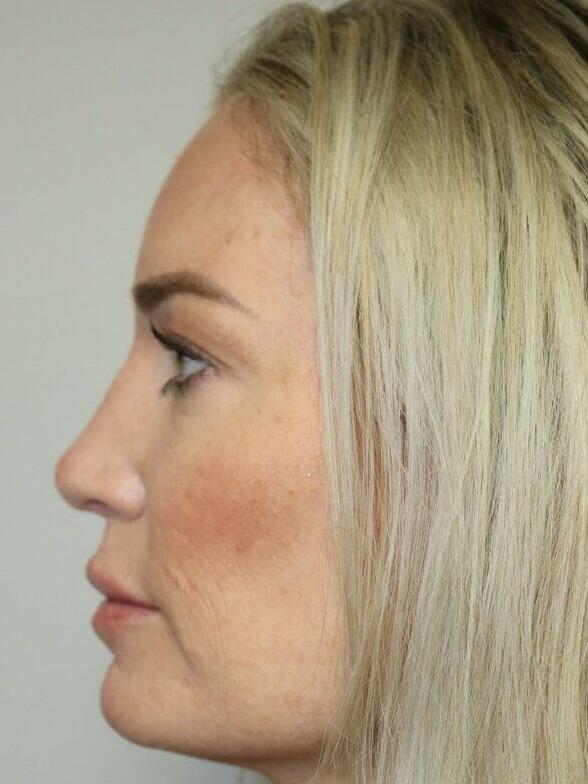 Rhinoplasty Before & After Image