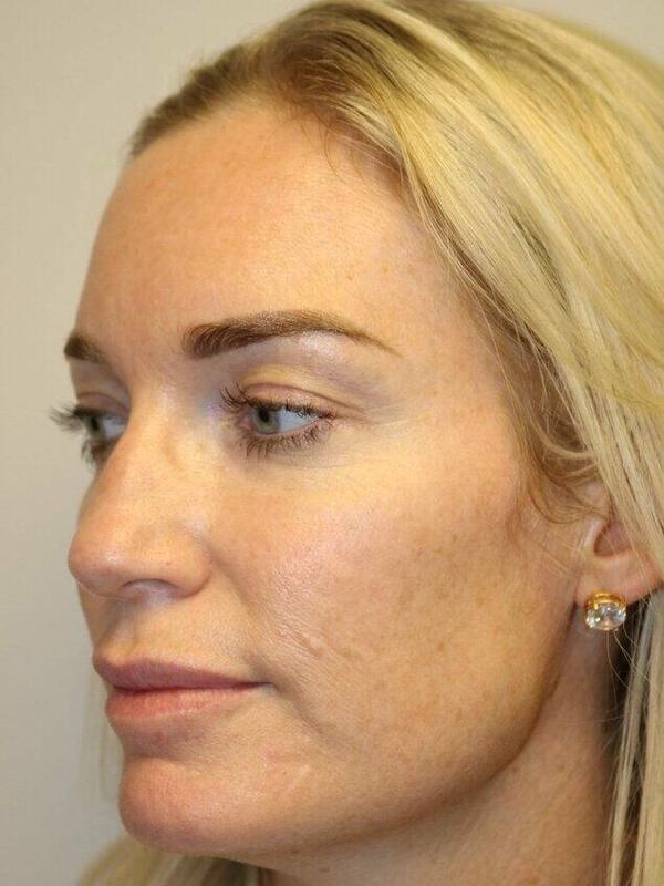 Rhinoplasty Before & After Image