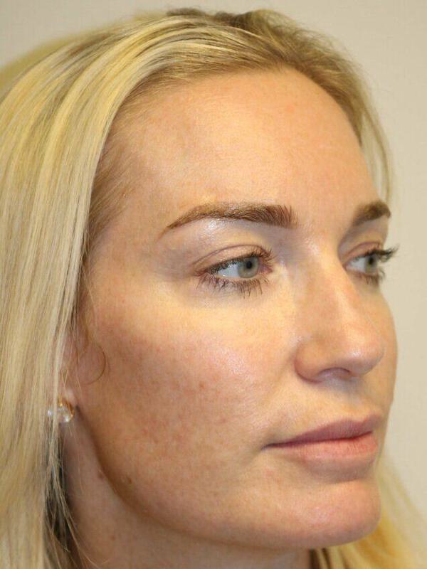 Rhinoplasty Before & After Image