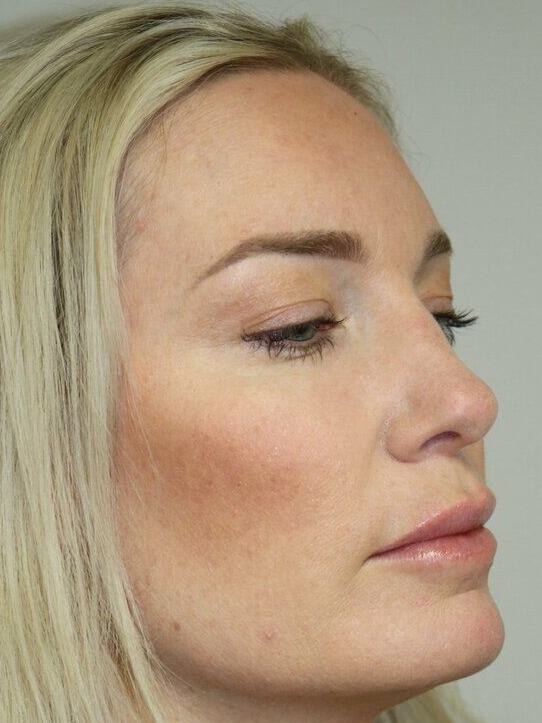 Rhinoplasty Before & After Image