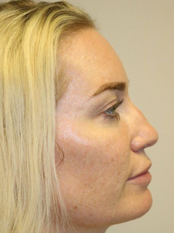 Rhinoplasty Before & After Image