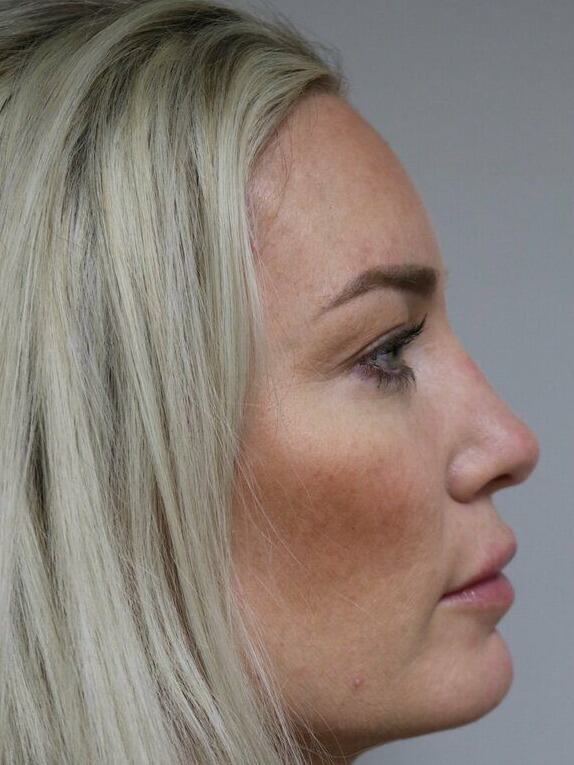 Rhinoplasty Before & After Image