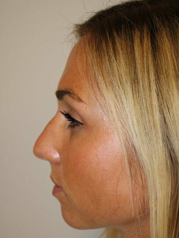 Rhinoplasty Before & After Image