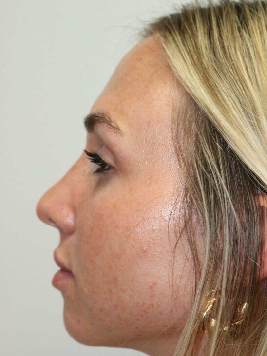 Rhinoplasty Before & After Image