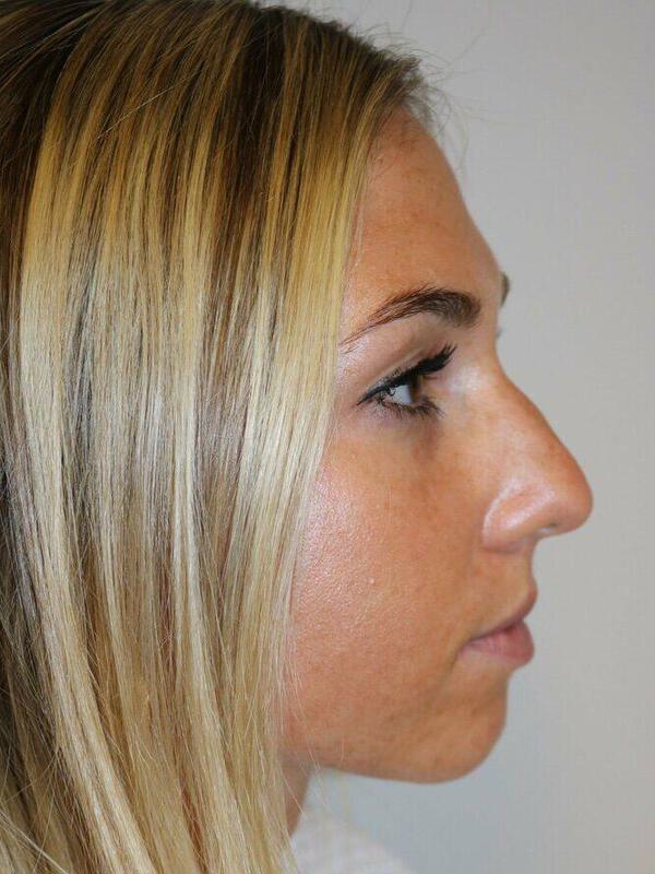 Rhinoplasty Before & After Image