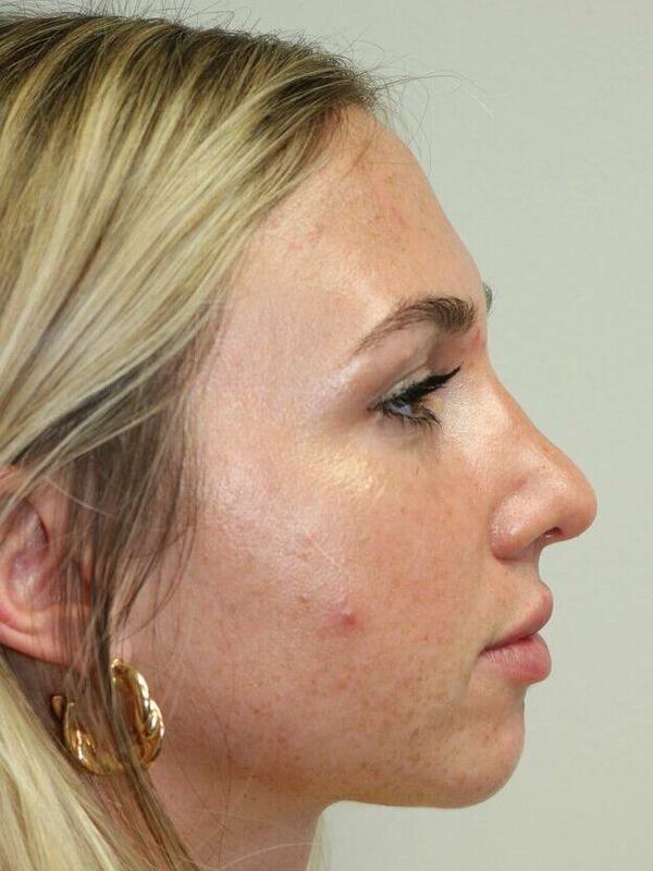 Rhinoplasty Before & After Image