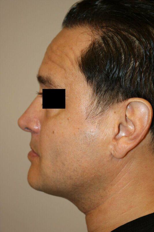 Rhinoplasty Before & After Image