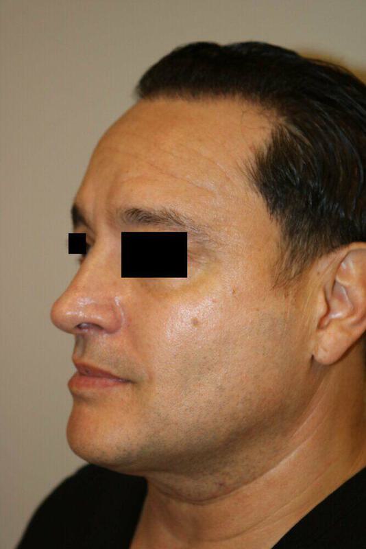 Rhinoplasty Before & After Image