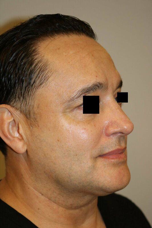 Rhinoplasty Before & After Image