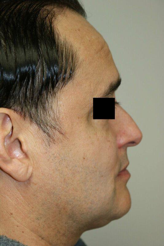 Rhinoplasty Before & After Image