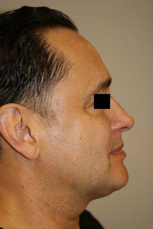 Rhinoplasty Before & After Image