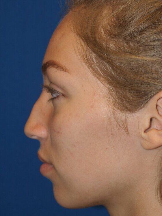 Rhinoplasty Before & After Image