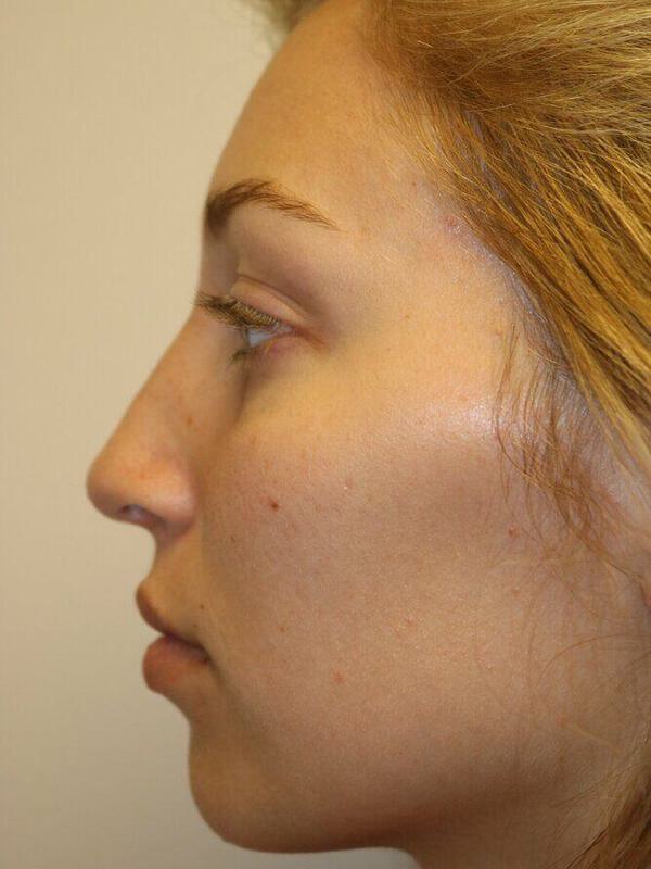 Rhinoplasty Before & After Image