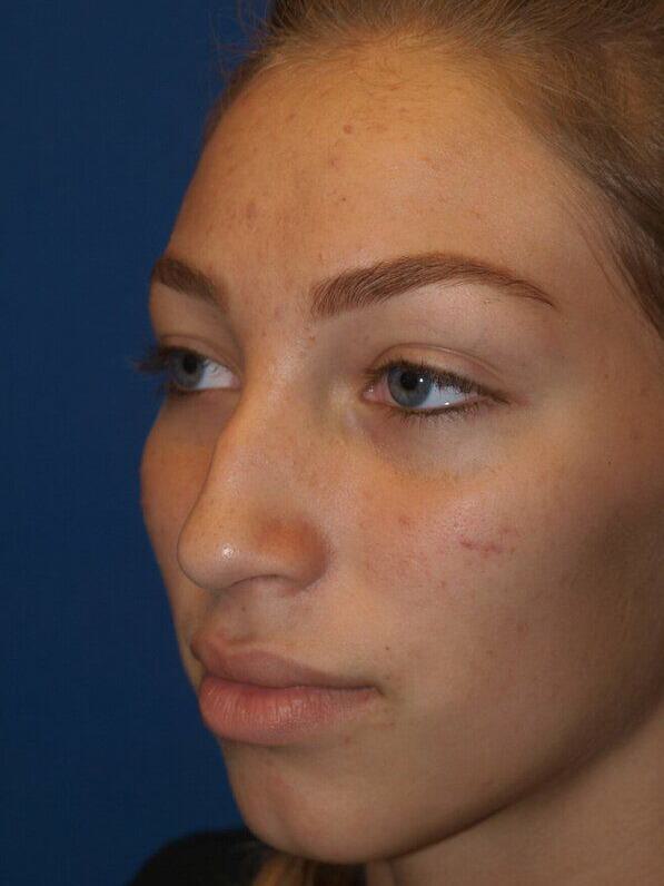 Rhinoplasty Before & After Image