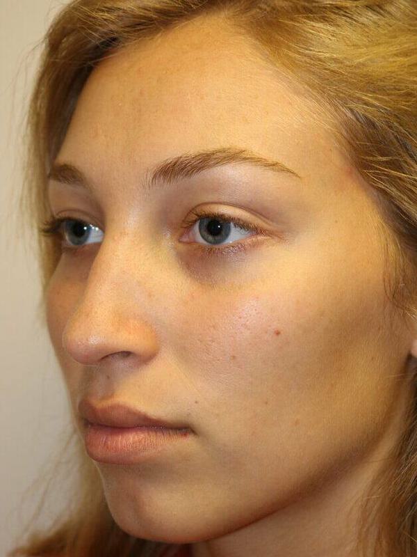 Rhinoplasty Before & After Image