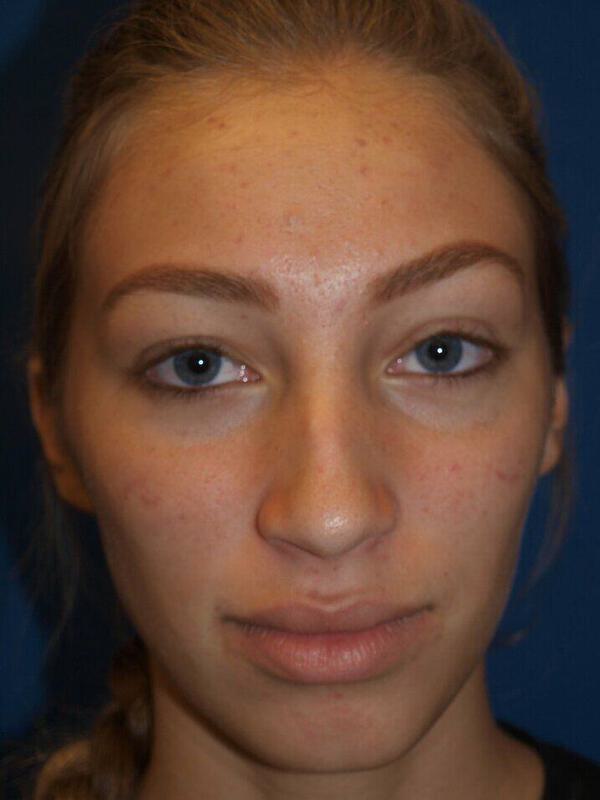 Rhinoplasty Before & After Image