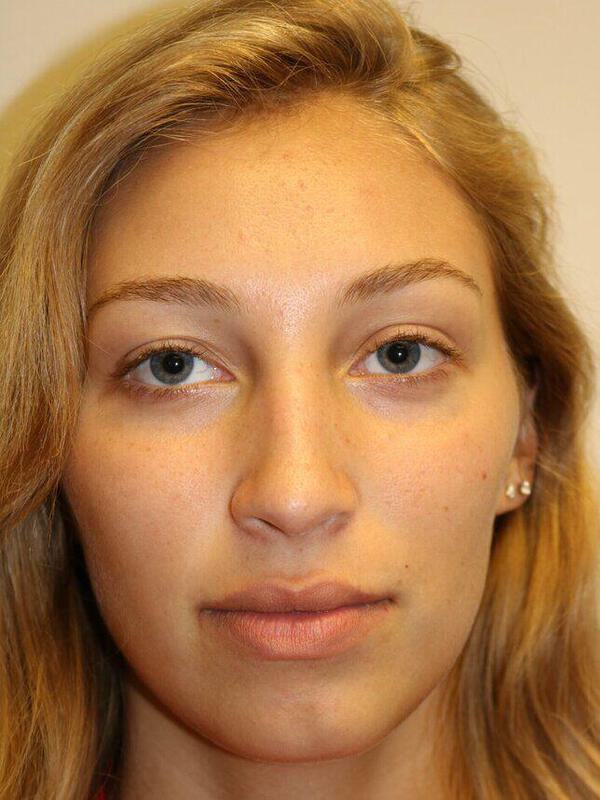 Rhinoplasty Before & After Image