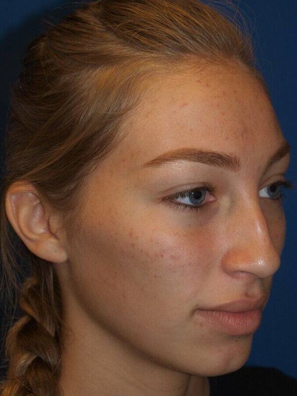 Rhinoplasty Before & After Image