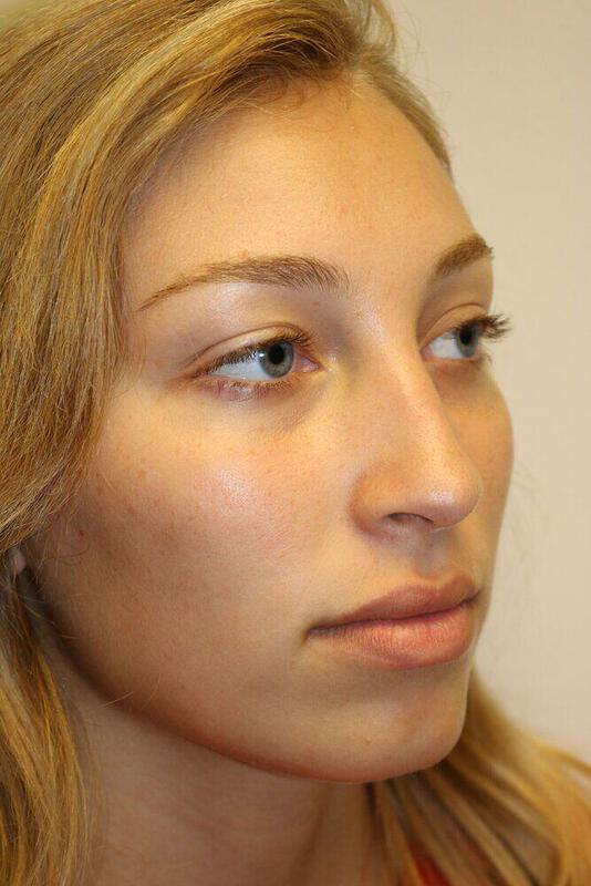 Rhinoplasty Before & After Image