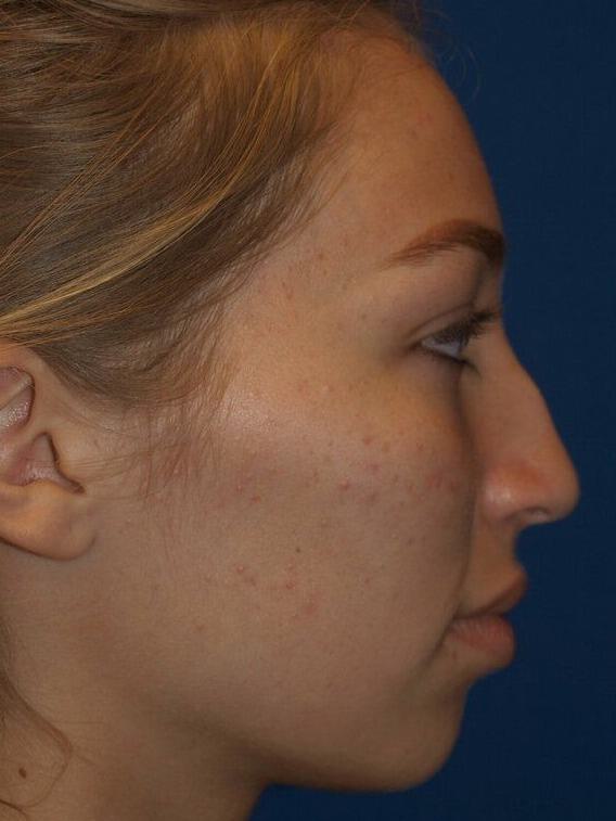 Rhinoplasty Before and After 04 | ARC Plastic Surgery