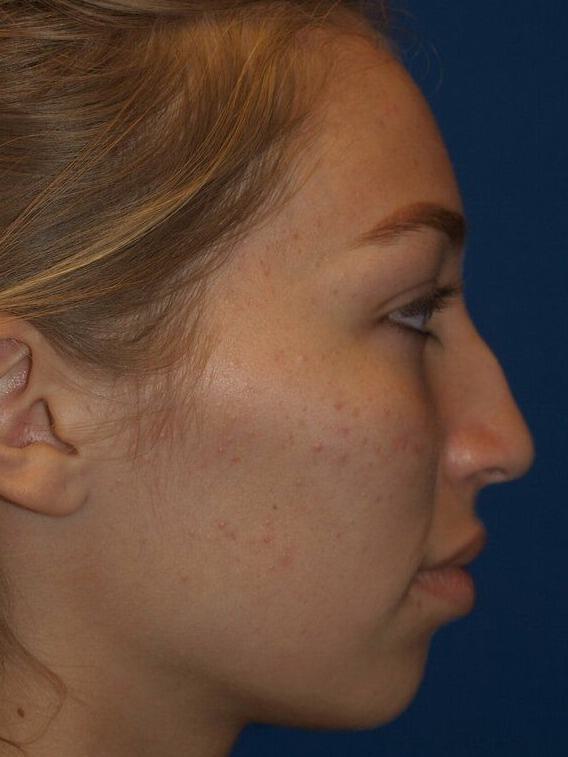 Rhinoplasty Before & After Image