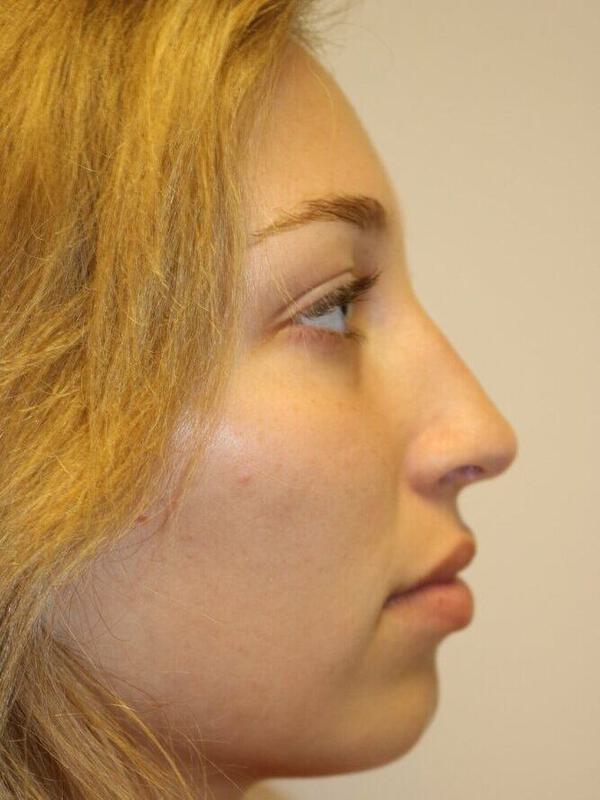 Rhinoplasty Before & After Image