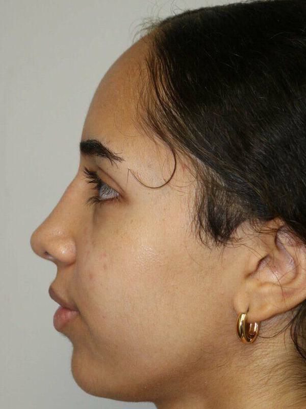 Rhinoplasty Before & After Image