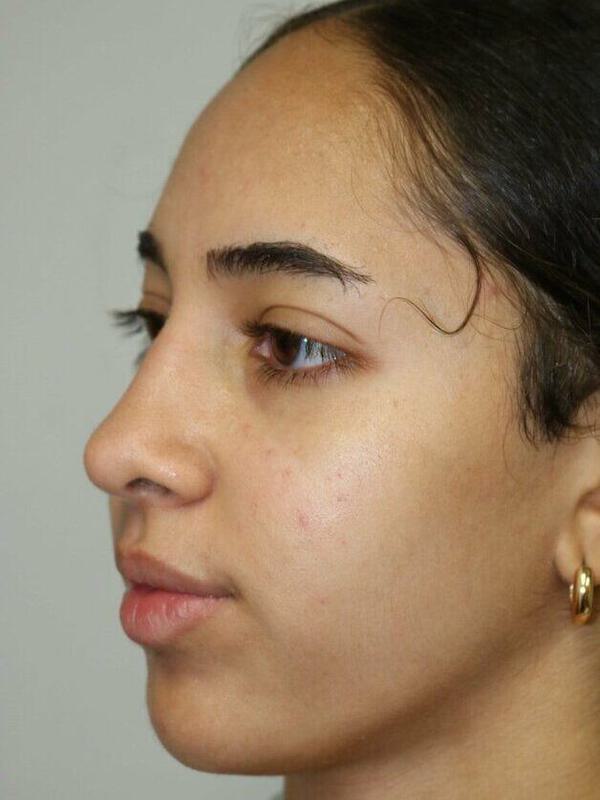 Rhinoplasty Before & After Image