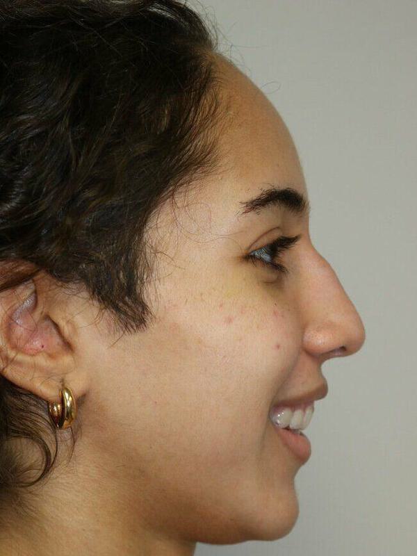 Rhinoplasty Before & After Image