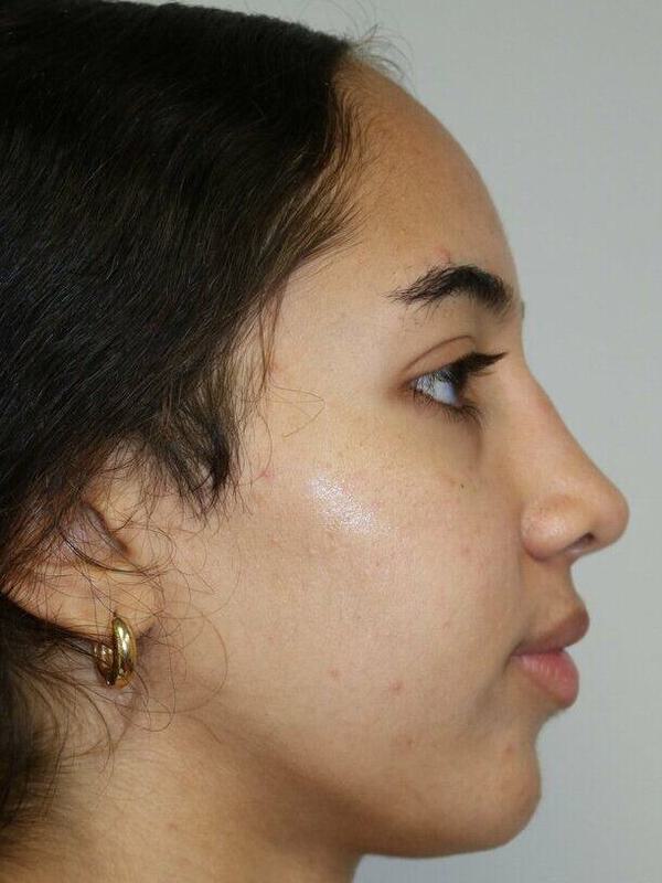 Rhinoplasty Before & After Image