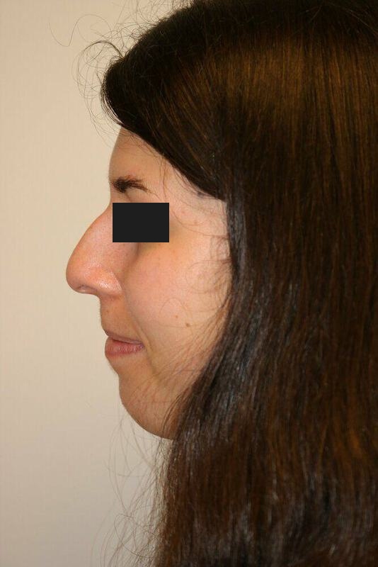 Rhinoplasty Before and After 08 | ARC Plastic Surgery