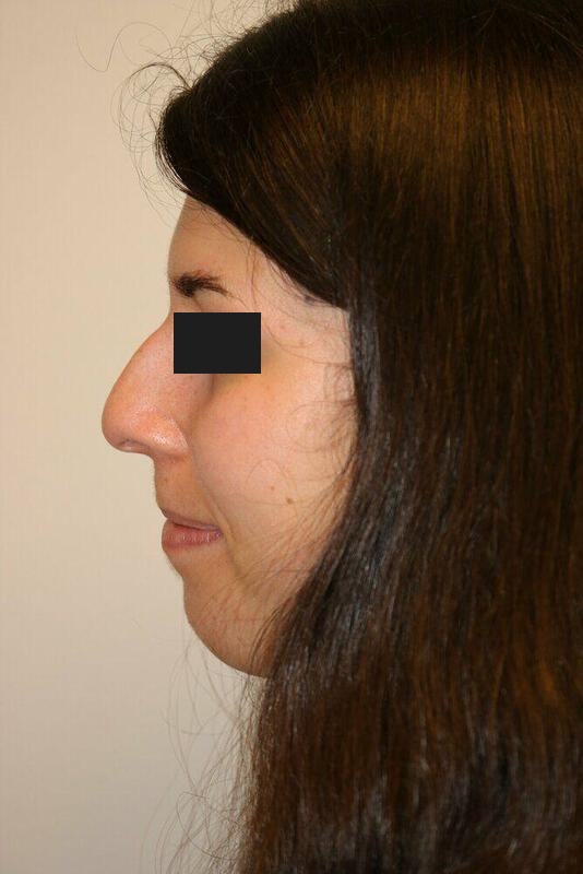 Rhinoplasty Before & After Image