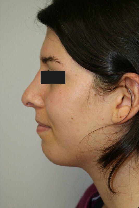 Rhinoplasty Before & After Image