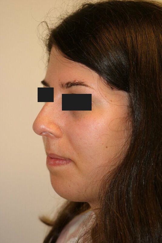 Rhinoplasty Before & After Image