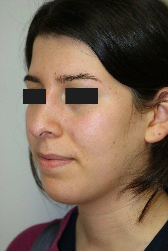 Rhinoplasty Before & After Image