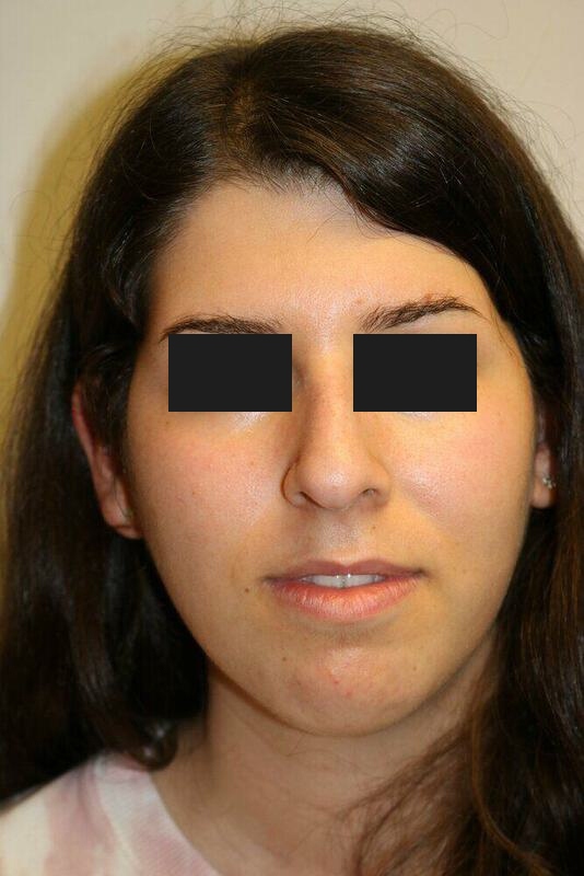 Rhinoplasty Before & After Image