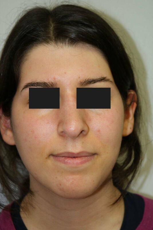 Rhinoplasty Before & After Image