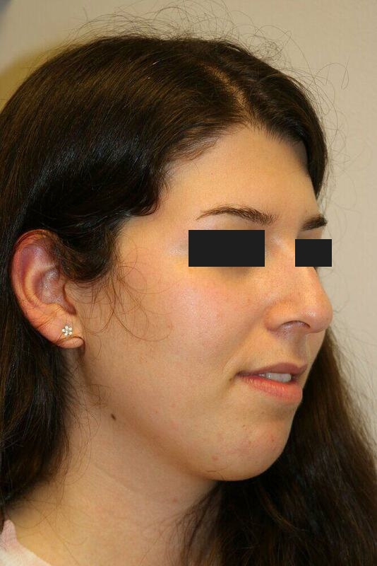 Rhinoplasty Before & After Image