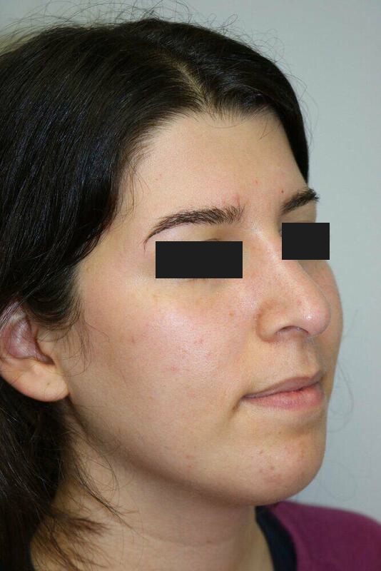 Rhinoplasty Before & After Image