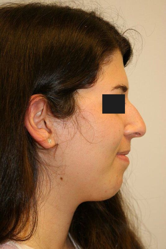 Rhinoplasty Before & After Image