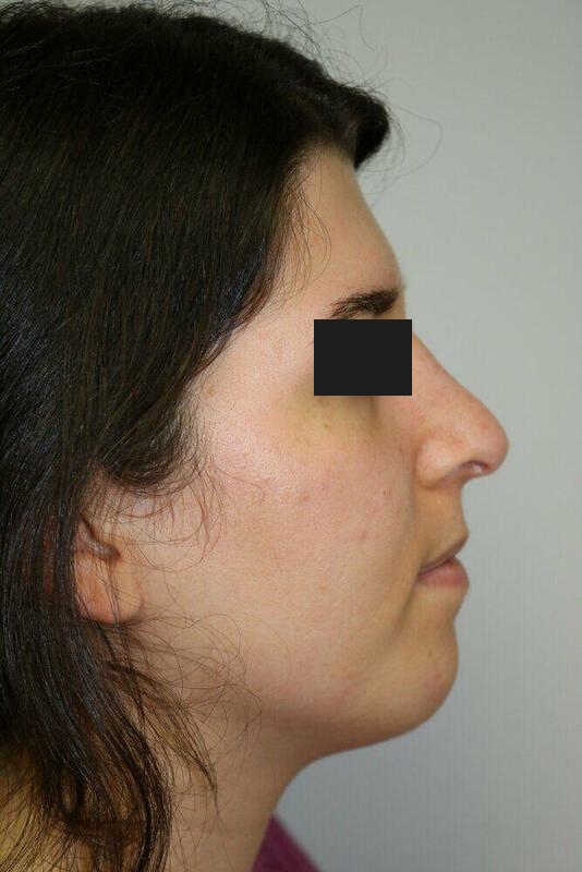 Rhinoplasty Before & After Image