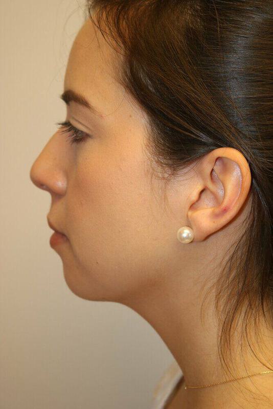 Rhinoplasty Before & After Image