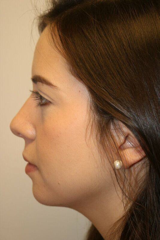 Rhinoplasty Before & After Image