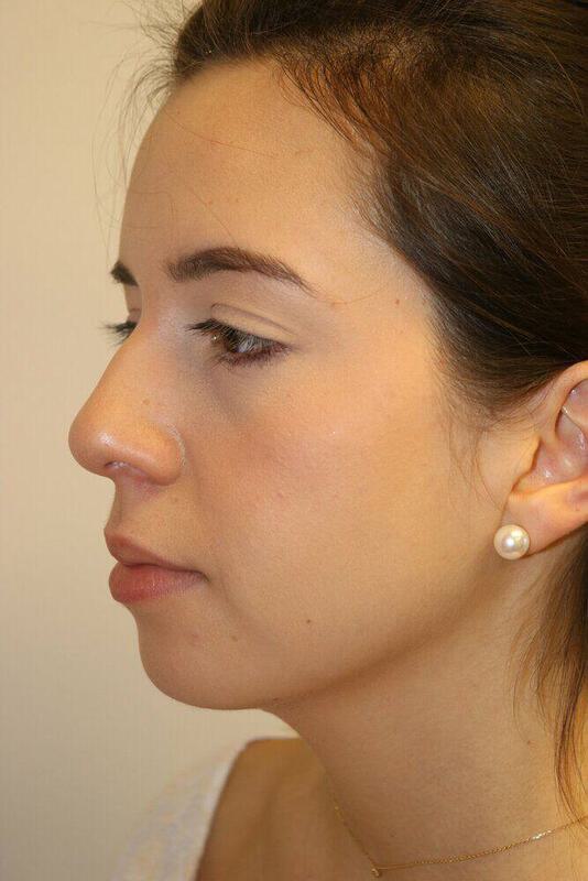 Rhinoplasty Before & After Image